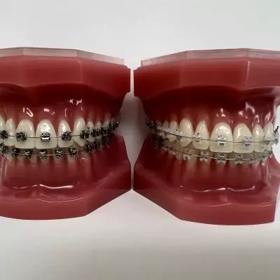 appareil multibagues, bagues metal , céramique adolescent Pornic