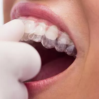 gouttière thermoformée de contention orthodontie Pornic