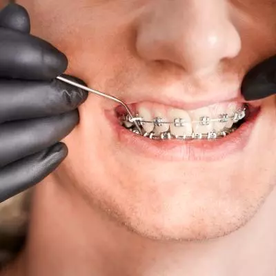 bagues décollées orthodontie Pornic  que faire 