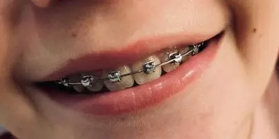 appareil dentaire adolescents pornic