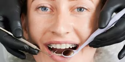 appareil dentaire bagues discrètes céramiques Pornic